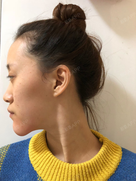 这个手术能使面部更饱满,下巴不仅取出了异物,但下巴_圈子-新氧美容