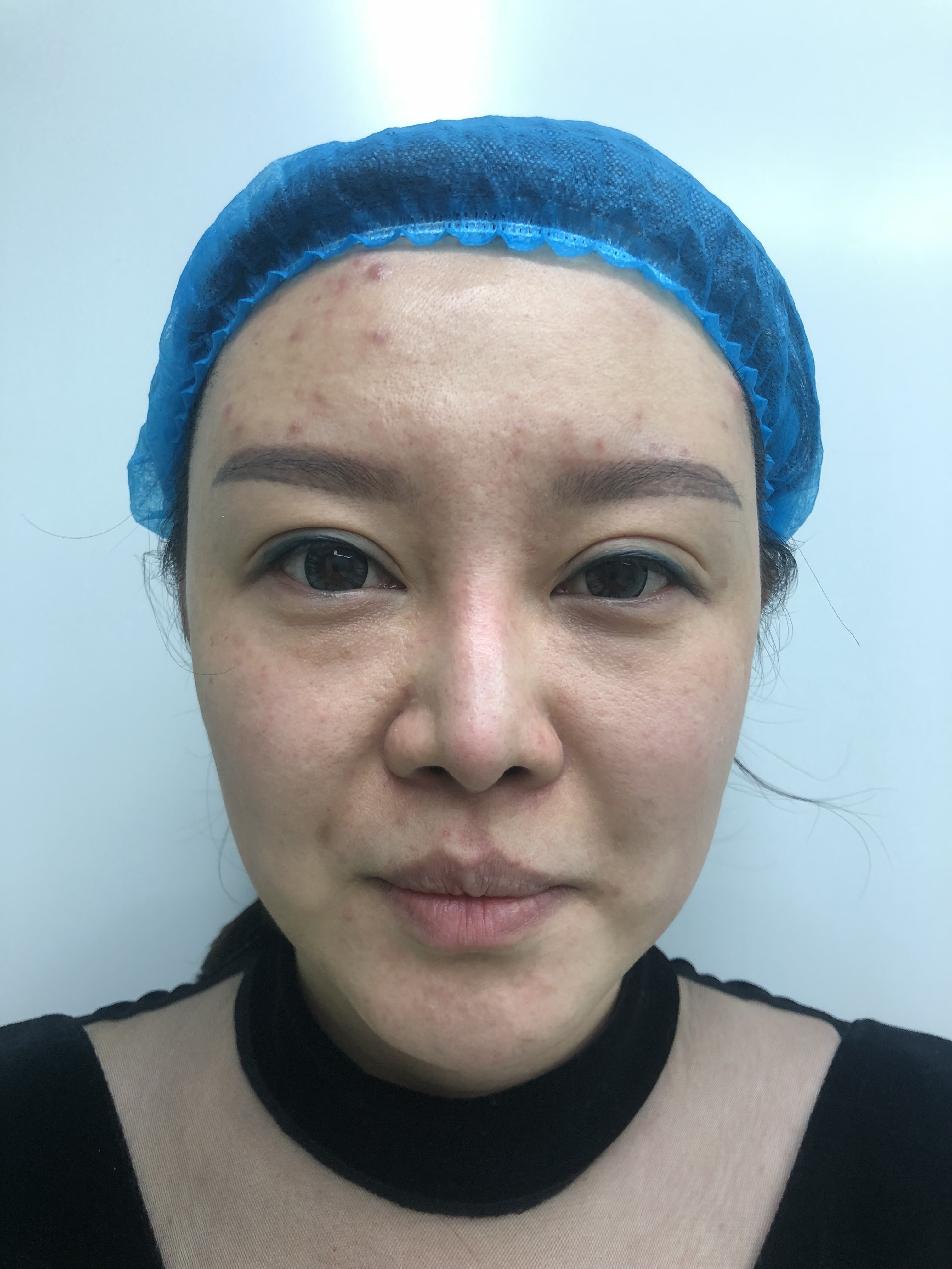 女孩33岁,面部有松弛下垂,通过面部埋线提升手术前术后对比图片. - 哔哩哔哩