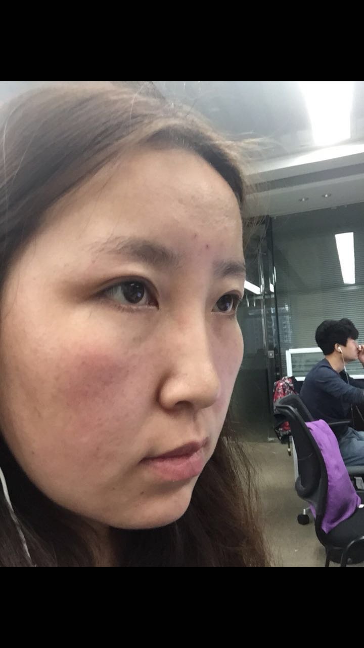 玻尿酸隆鼻怎么样_恢复过程_效果如何_bala啦