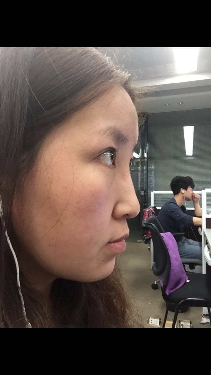 玻尿酸隆鼻怎么样_恢复过程_效果如何_bala啦