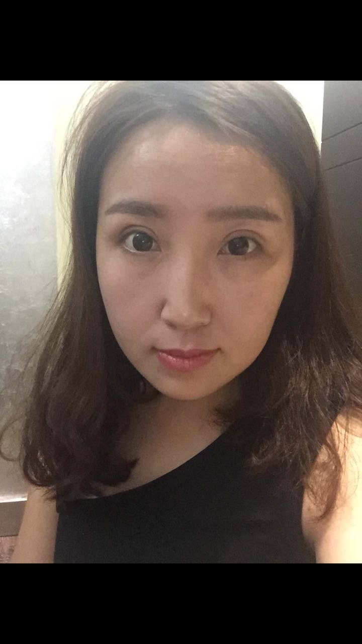 玻尿酸隆鼻怎么样_恢复过程_效果如何_bala啦