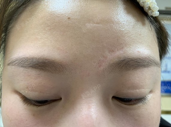【凹陷疤痕】我这个疤痕在左边眉毛上,挺明显的,是去年不小心摔伤留下