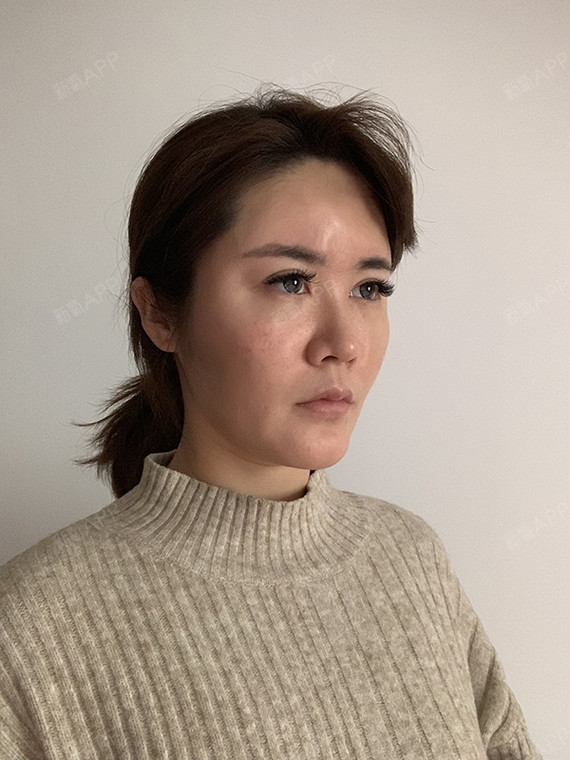 济南星范医美纳米脂肪填充术后即刻生完宝宝从180斤