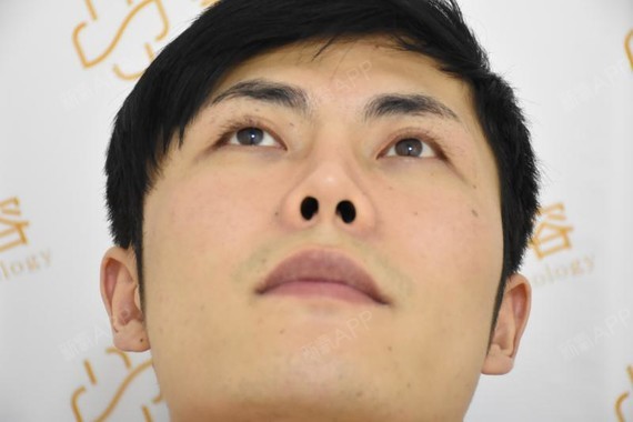【长沙素妍医疗美容】男生做鼻子应该算是蛮少见的吧.