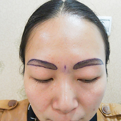 【仁爱植发·种植眉毛】时光转瞬即逝,植眉已经3个月_圈子-新氧美容