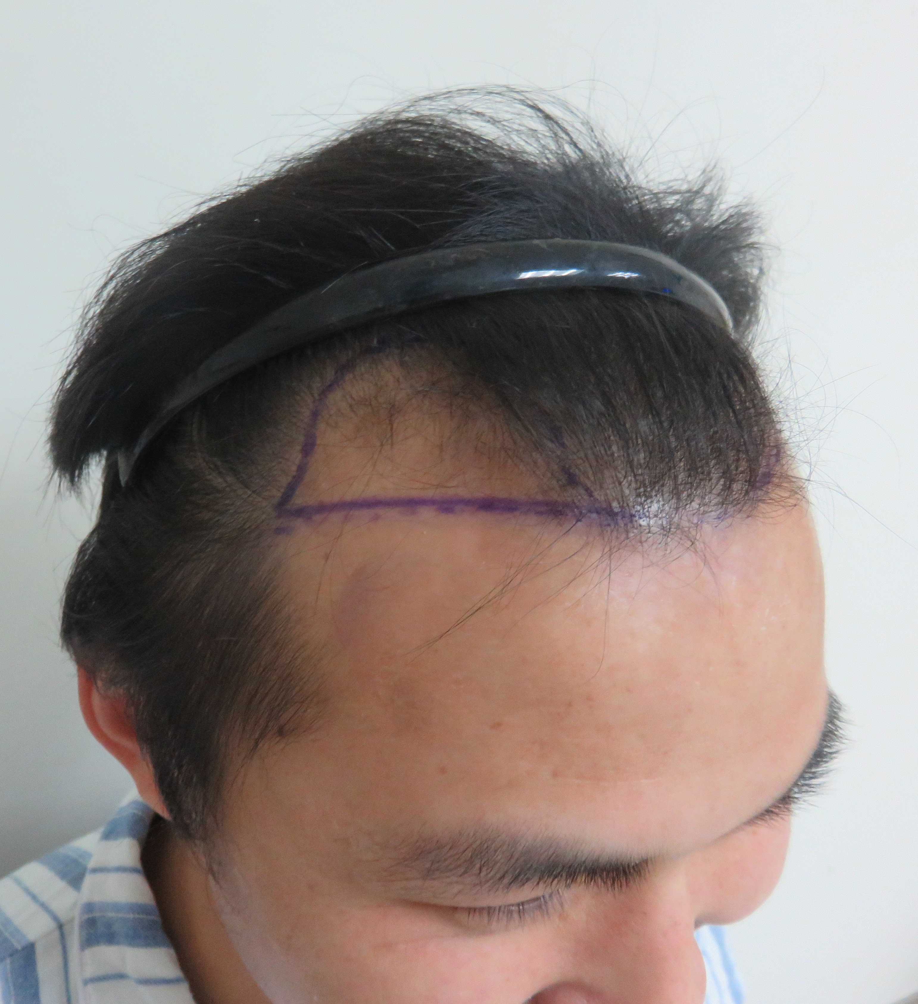 北京画家纹发际线/我的发际线拯救我的小秃头 - 知乎