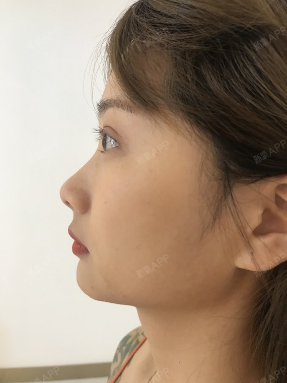 做完手术也有一段时间了,下巴的形态越来越自然了,就_圈子-新氧美容