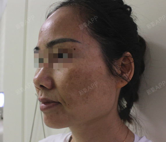 看看我的脸,是被重金属给伤害了,以前不懂在美容院用_圈子-新氧美容