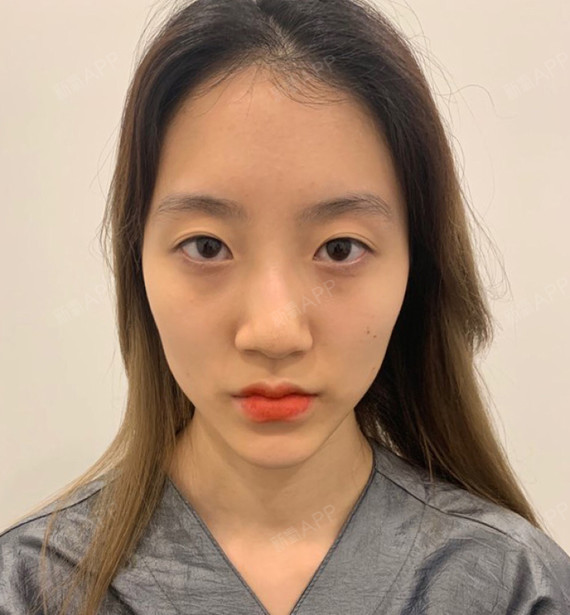 玻尿酸