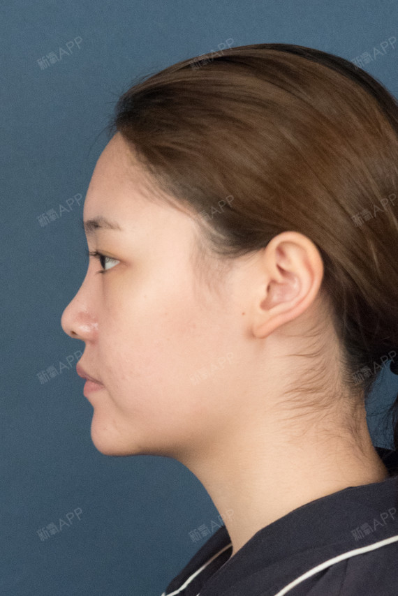 【异体骨隆鼻】第一次做手术项目,还是蛮紧张的.