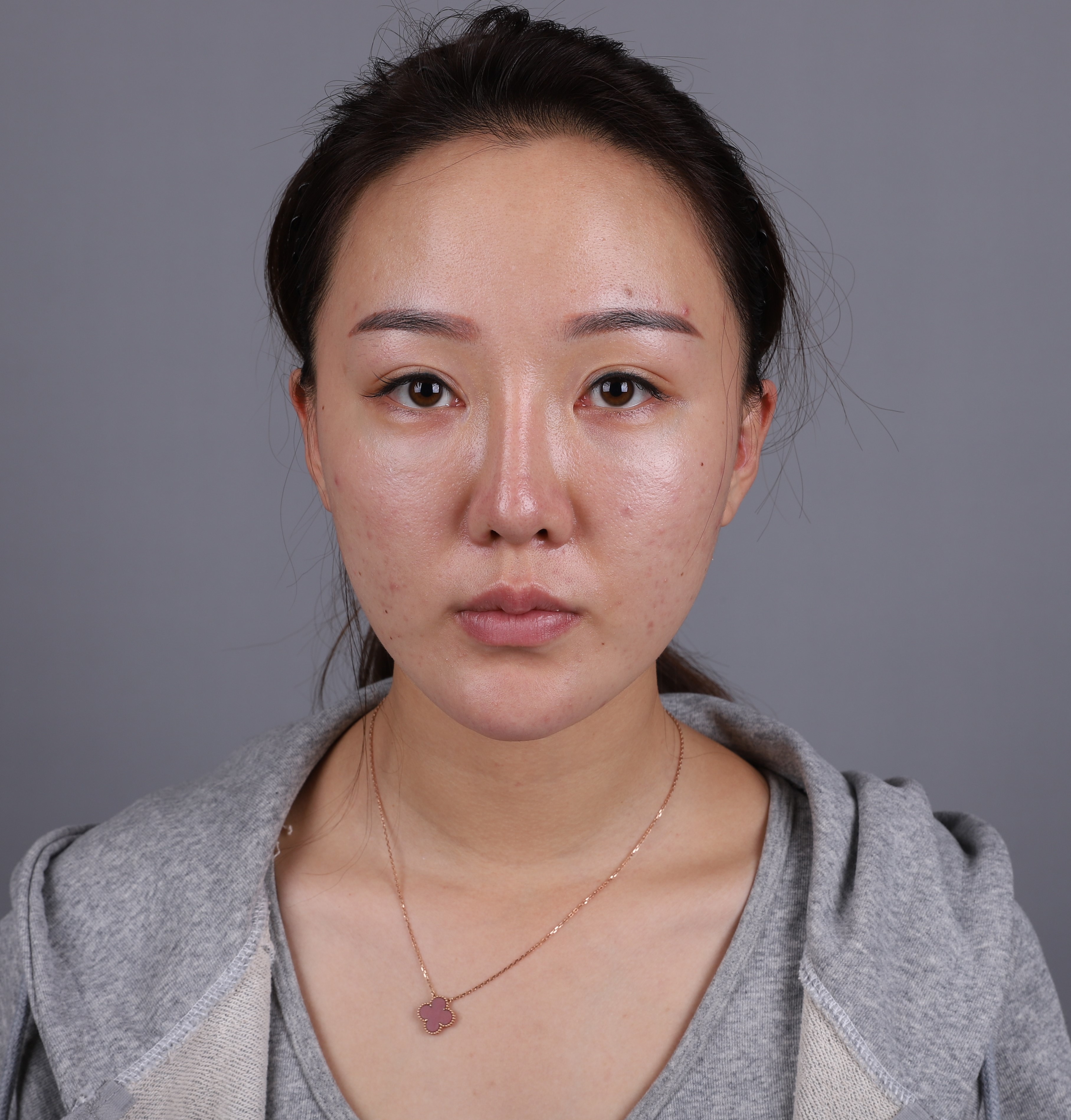 长沙柒和医疗美容鼻部修复怎么样 恢复过程 效果如何 小雪雪儿整形日记1 5 新氧美容整形