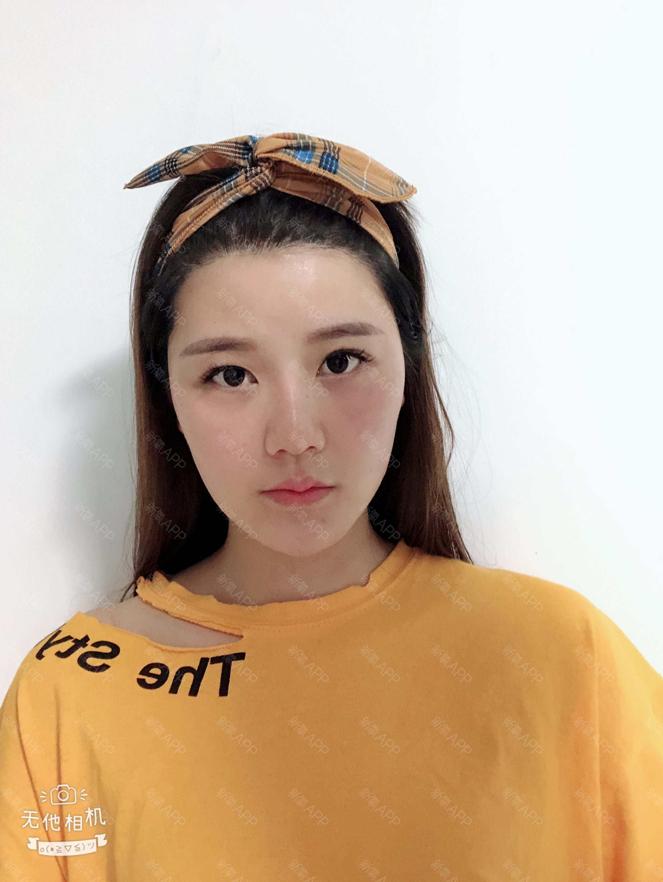 南宁连美整形(刘泳铖院长)切开双眼皮怎么样_恢复过