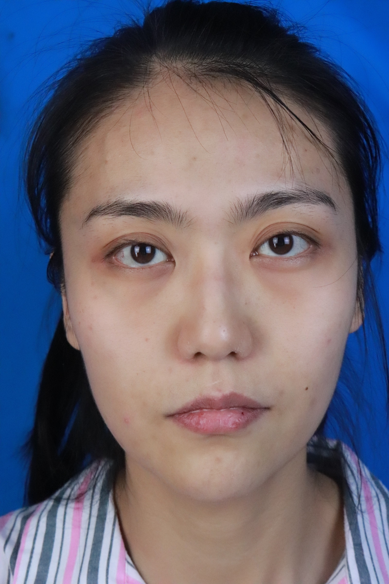 自体脂肪全脸填充怎么样_恢复过程_效果如何_wuli小俊俊整形日记7.