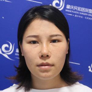 佛山鼻综合好不好_效果图_七月份的尾巴狮子座鼻综合术后第20天_新氧