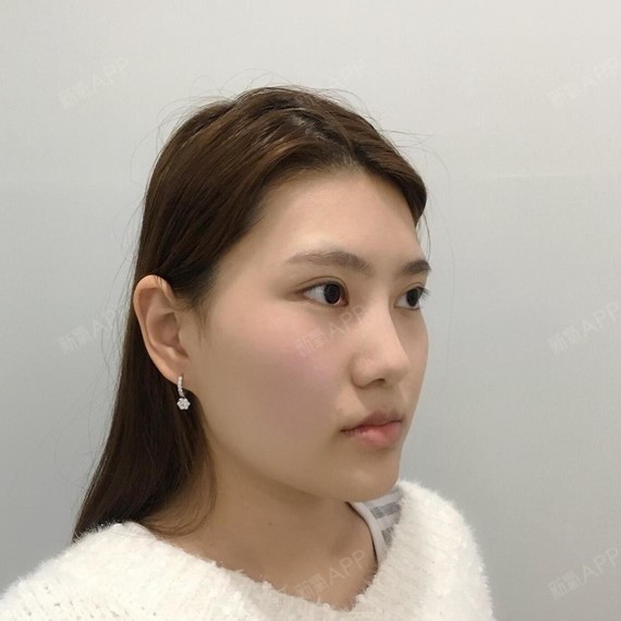 我的牙齿有反颌,地包天的情况,所以下巴看着有点前倾_圈子-新氧美容