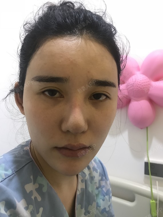鼻部假体取出的术后一个星期,鼻子恢复得还行,现在刚_圈子-新氧美容