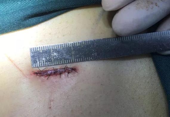 【科普:肋软骨在鼻部多项整形应用的基本过程】