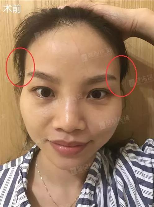 太阳穴凹陷很显老?想不到靠"脂肪"就能解决!