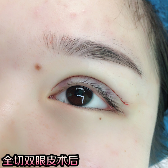 眼睛对于颜值的重要性毋庸置疑,一次成功的双
