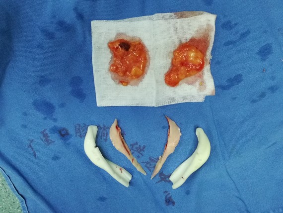下颌角截骨手术(改脸型)的黑科技