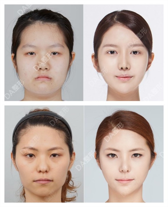 韩国da整形医院【如何拯救方形脸?】