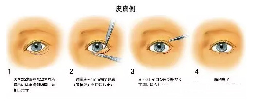 下眼睑下至术(眼睑下至)