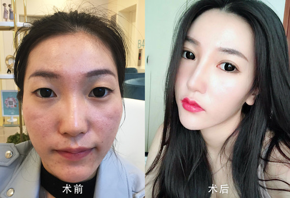 术后,双眼有神,气质提升了很多.对比照大家看看.