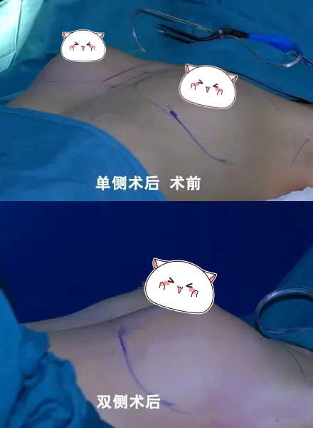 隆胸手术假体放入过程图片