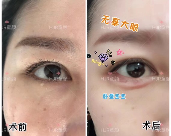 卧蚕跟眼袋是两回事"卧蚕"也称眼台,是紧邻睫毛下缘_圈子-新氧美容