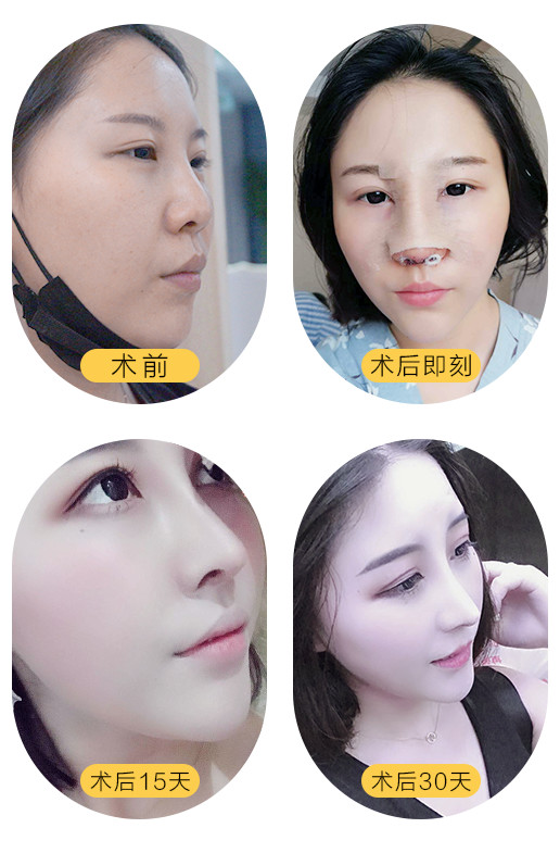 鼻子好不好看的关键,想做隆鼻的你注意了