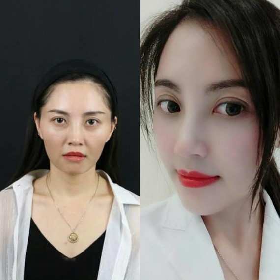 种草杭州时光——玻尿酸填充让我重返少女时代