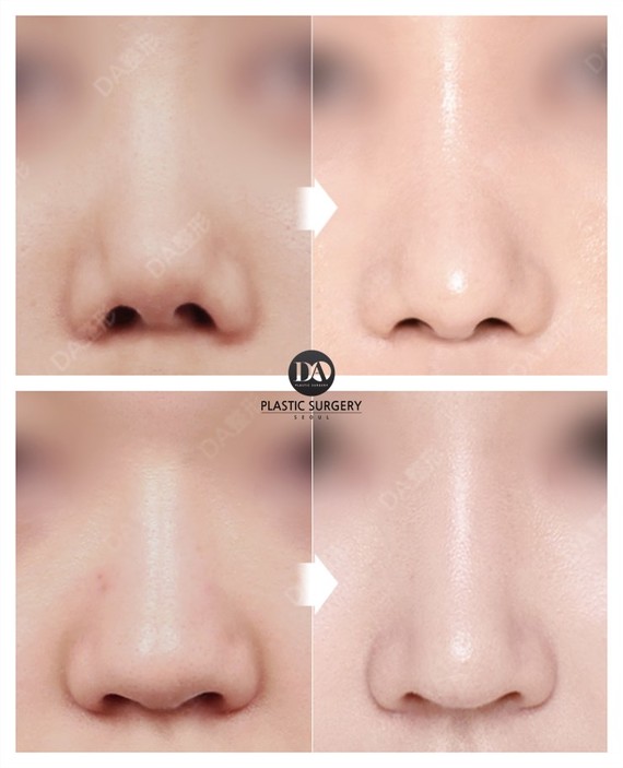 根据脸部均匀来设计鼻柱和鼻尖模样,将选择"半步袜尖型","直线型","直