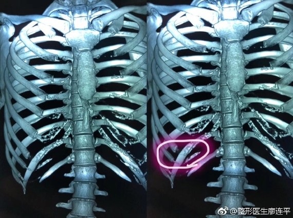 肋软骨钙化是怎么回事?