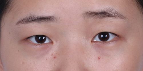 (先天大小眼,两眼不对称)