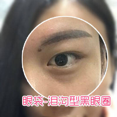 想消灭黑眼圈,要先知道你是哪一种黑眼圈类型.