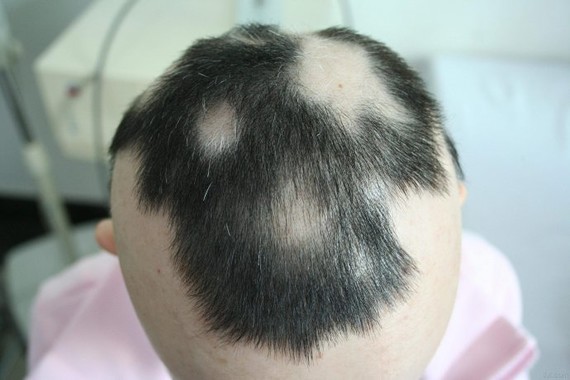 斑秃患者属于短暂的刺激性脱发,在不确定是否会再次生长前不建议当