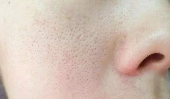 科普毛孔为啥小不了3大雷区你踩了多少