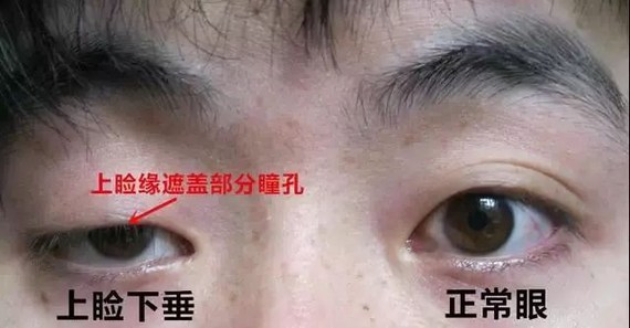 而开了内眼角之后,内眦赘皮的垂直张力会消失,根据张力的不同,手术后