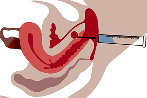 玻尿酸缩阴:通过玻尿酸注射填充修复阴道被破损的皮肤组织.