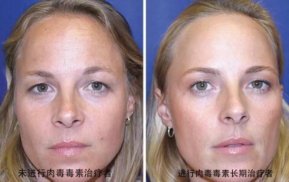 肉毒素长期美容的效果观察