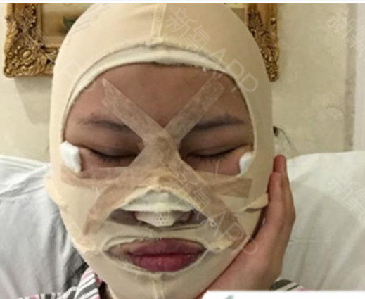 刚做了大拉皮手术太恐怖了,做过拉皮手术后悔要死,咋_圈子-新氧美容