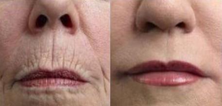 口周皱纹也被称为吸烟者纹,是沿着嘴唇及口周的放射状皱纹,与口轮匝肌