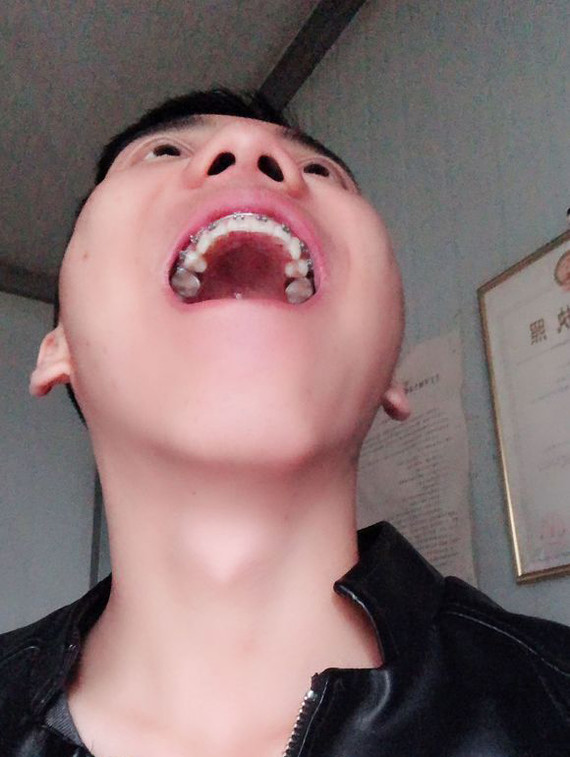 98年"小哥哥箍牙"8个月分享今年一月份戴的牙套,_圈子-新氧美容整形