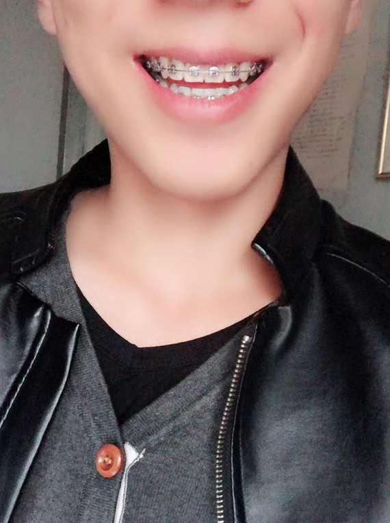 98年"小哥哥箍牙"8个月分享今年一月份戴的牙套,_圈子-新氧美容整形