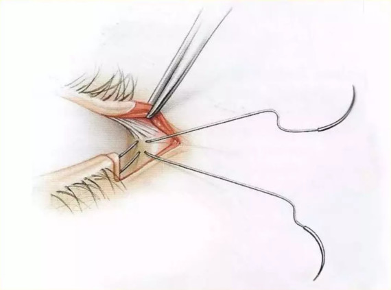 外眦的解剖结构与外眦开大术