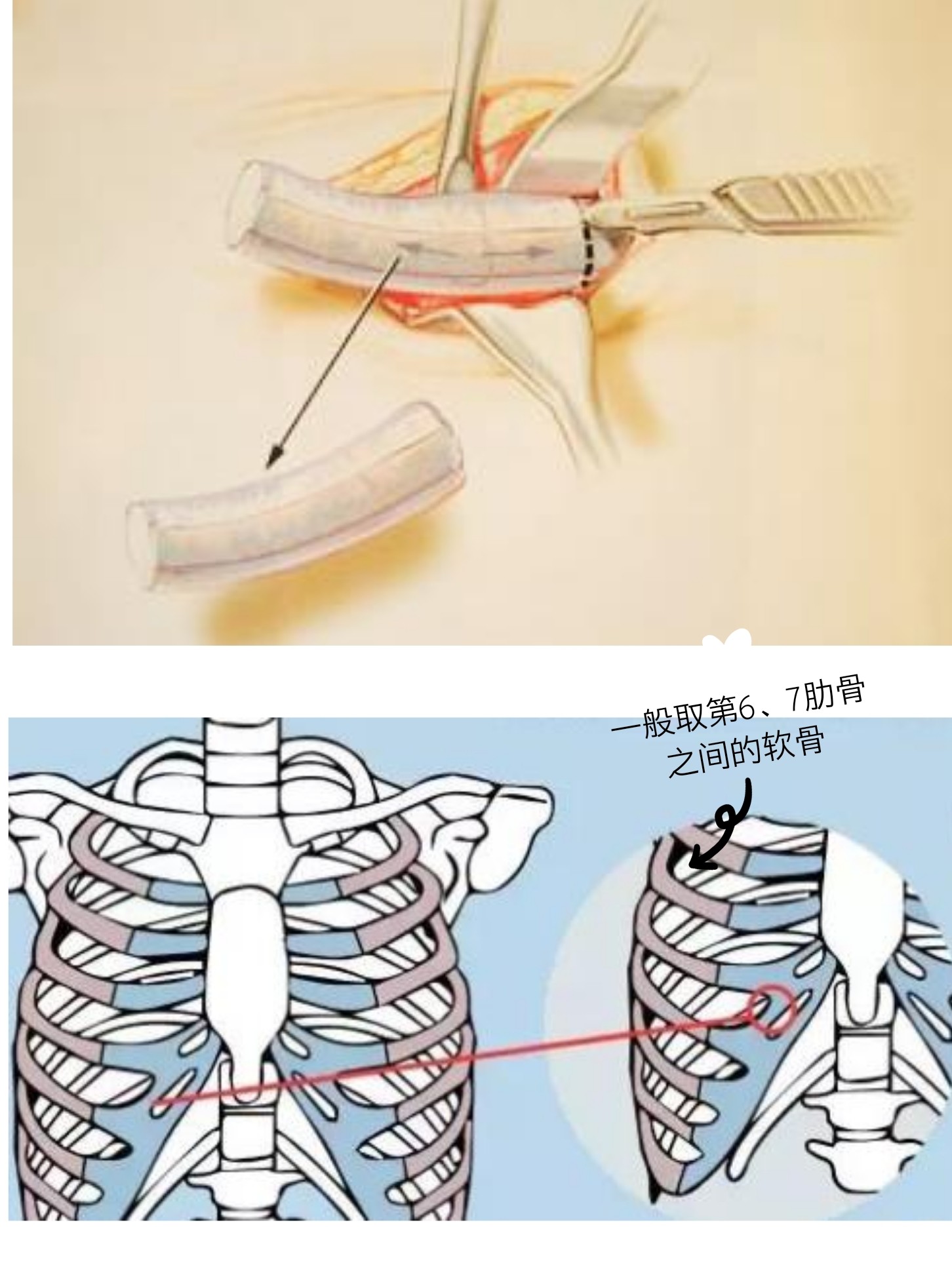 听说肋软骨会变弯?