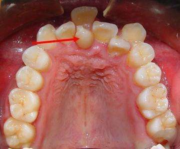 多生牙,从字面的意思去看就是多出来的牙齿,为什么这么说的,因为它长