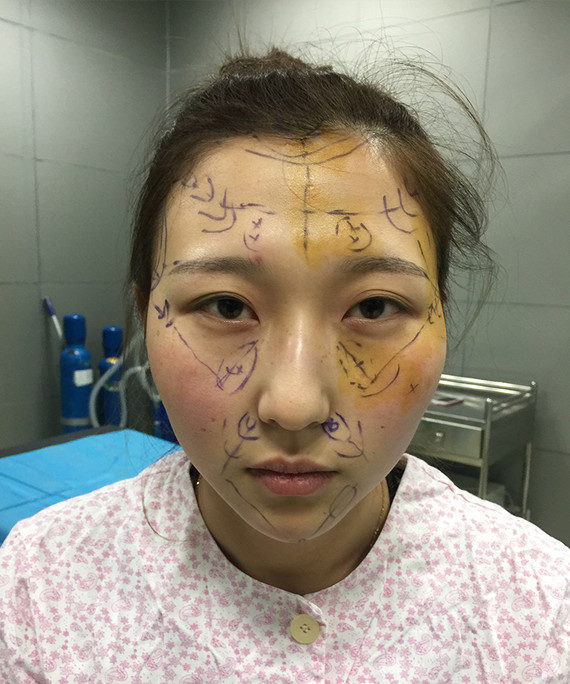 自体脂肪面部填充过多_自体脂肪面部填充后恢复_自体面部脂肪填充疼吗