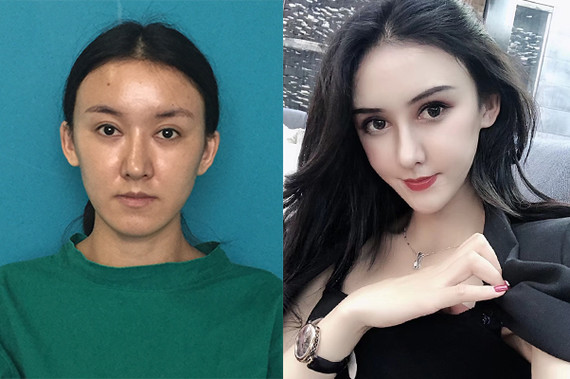 案例分享丰眉弓选择脂肪,不是太理想的方式.