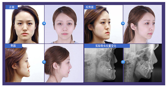 【瘪嘴显老态怎么办?菲斯莱茵的z童颜双鄂手术】
